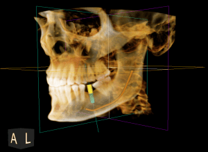3D model of a patient's skull