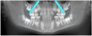 X-ray showing wisdom teeth interfering with the eruption of second molars