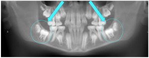X-ray showing wisdom teeth interfering with the eruption of second molars