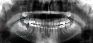 X-ray showing an improperly positioned second molar tooth