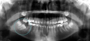 X-ray showing an improperly positioned second molar tooth