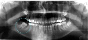 X-ray showing a second molar tooth with its position corrected
