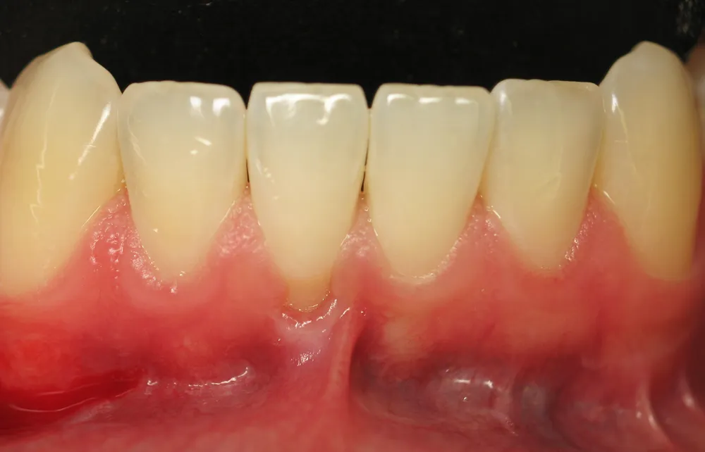 Tightly attached Lower Midline Labial Frenum causing gum tissue recession