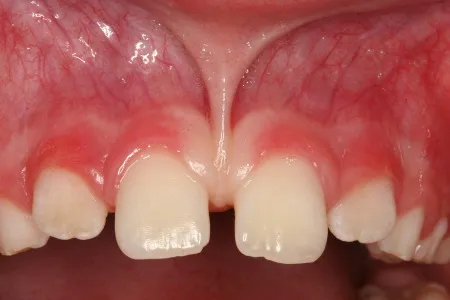 Tightly attached Upper Lip Frenum