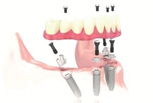 Diagram of the All-on-4 procedure (Full Arch Dental Implant Replacement)
