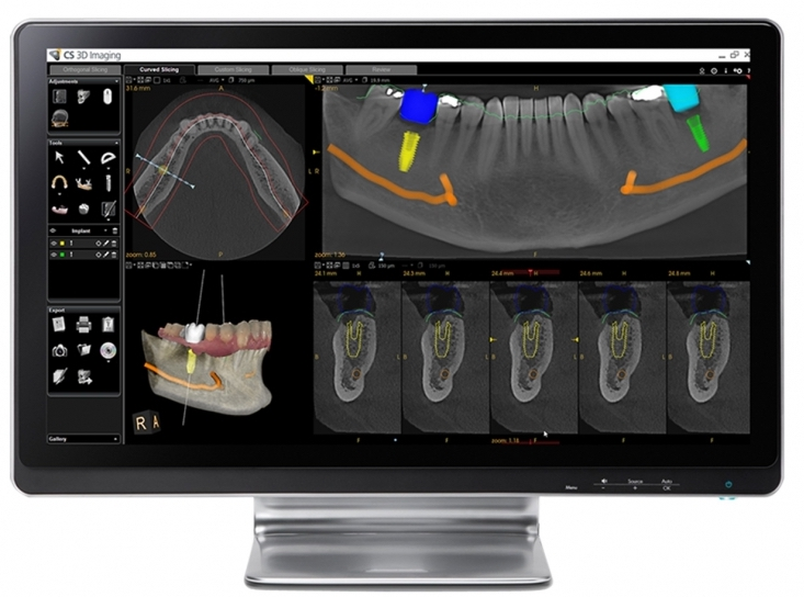 Schedule this appointment before your dental implant surgery for evaluation
